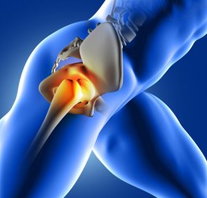 Hip-PRP-Regenerative-Medicine-Lafayette-NJ